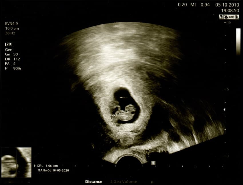 Échographie fœtus de 2 mois
